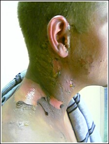 burn.jpg (19185 bytes)